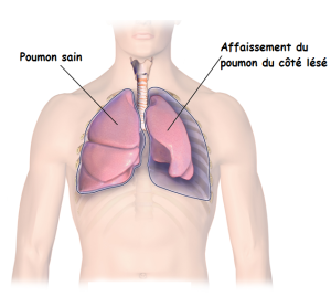 Illustration de l'affaissement d'un poumon suite à un pneumothorax